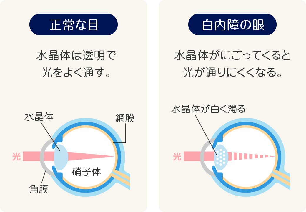 正常な眼と白内障の眼