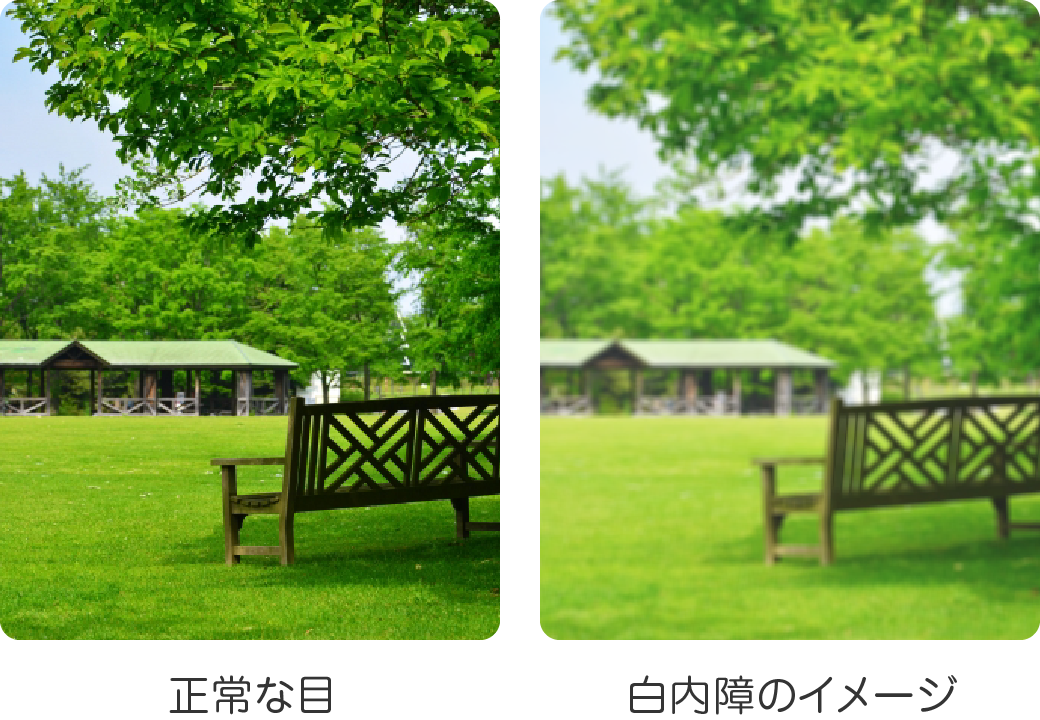 正常な眼の見え方と白内障の眼の見え方	